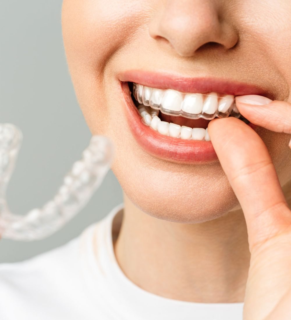 alinhadores-invisíveis-invisalign-em-são-joão-del-rei-nio-odontologia