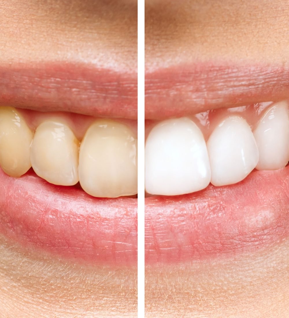 clareamento-de-dente-em-são-joão-del-rei